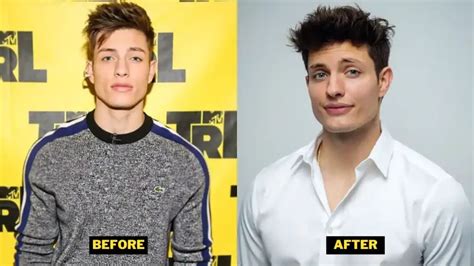 matt rife before and after plastic surgery|Matt Rife Reveals Real Reason Behind His Dramatic Facial